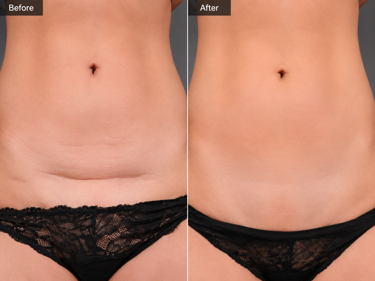 Before and after C-section shelf treatment with Claravive Scar Repair Stick